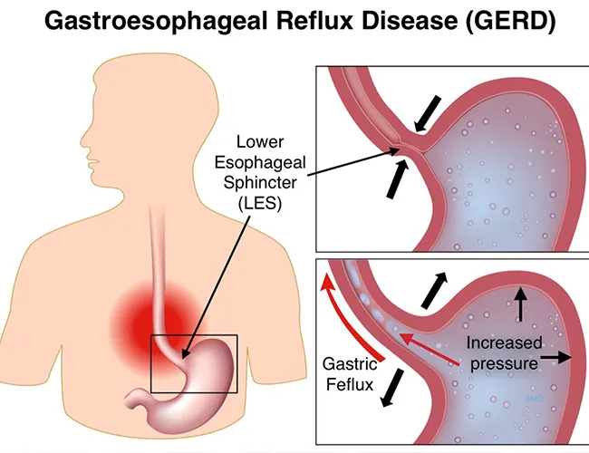 Gastroesophageal Reflux Disease (GERD) in Children