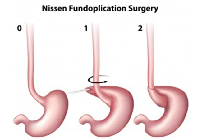Treating Gastroesophageal Reflux Disease (GERD) in Children