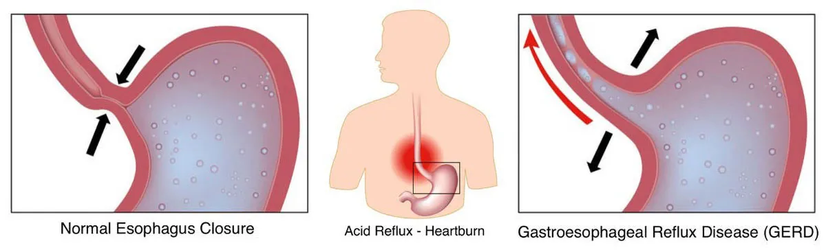 Gastroesophageal Reflux Disease (GERD)