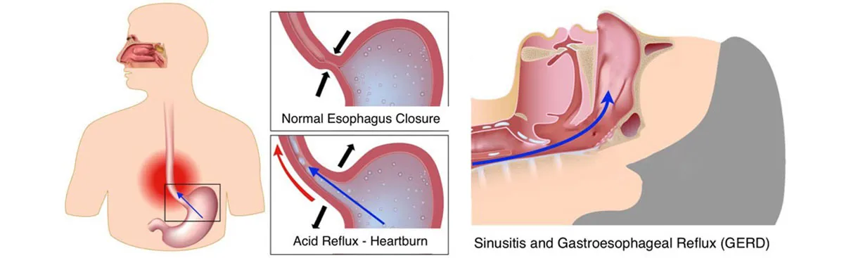 Gastroesophageal Reflux Disease (GERD)