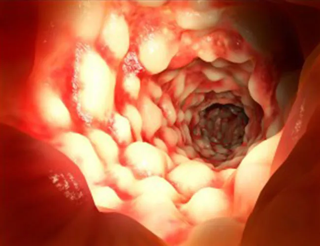 Diagnosis of Crohn’s Disease