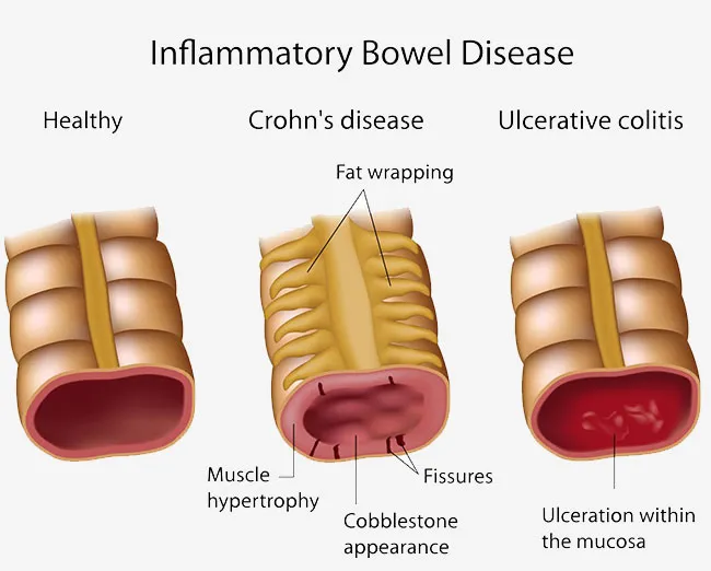 Crohn’s Disease in Children