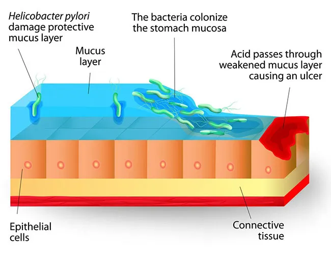 Diagnosing Peptic Ulcers in Children