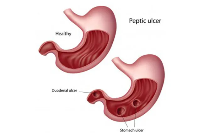Peptic Ulcer in Children