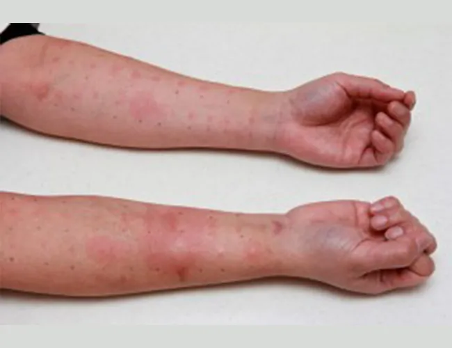 Testing for Food Allergies in Children