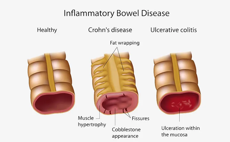 Ulcerative Colitis (UC)