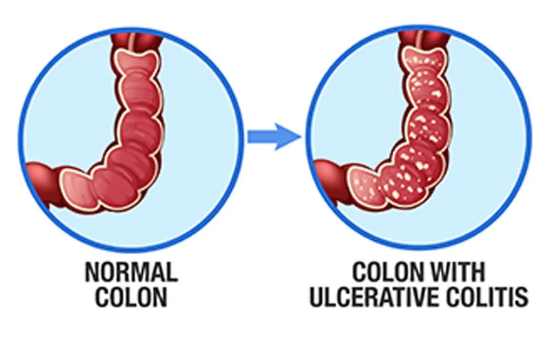 Treating Ulcerative Colitis in Children