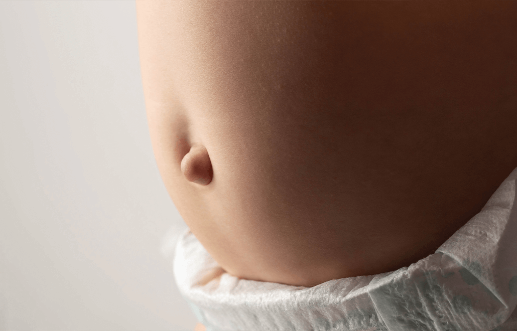 Understanding Umbilical Hernias in Babies and Children: What Parents Should Know