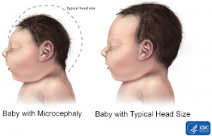 microcephaly