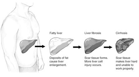 Fatty_Liver_5