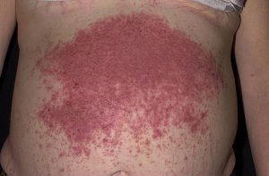 dermatitis herpetiformis_1