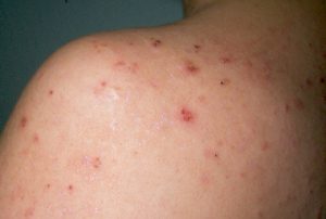 dermatitis herpetiformis_2