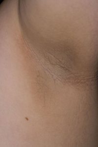 acanthosis nigricans