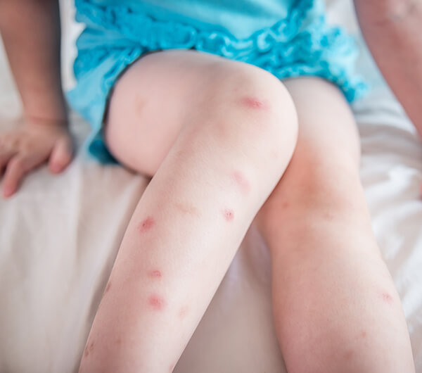 Allergic Reactions from Insect Bites and Stings
