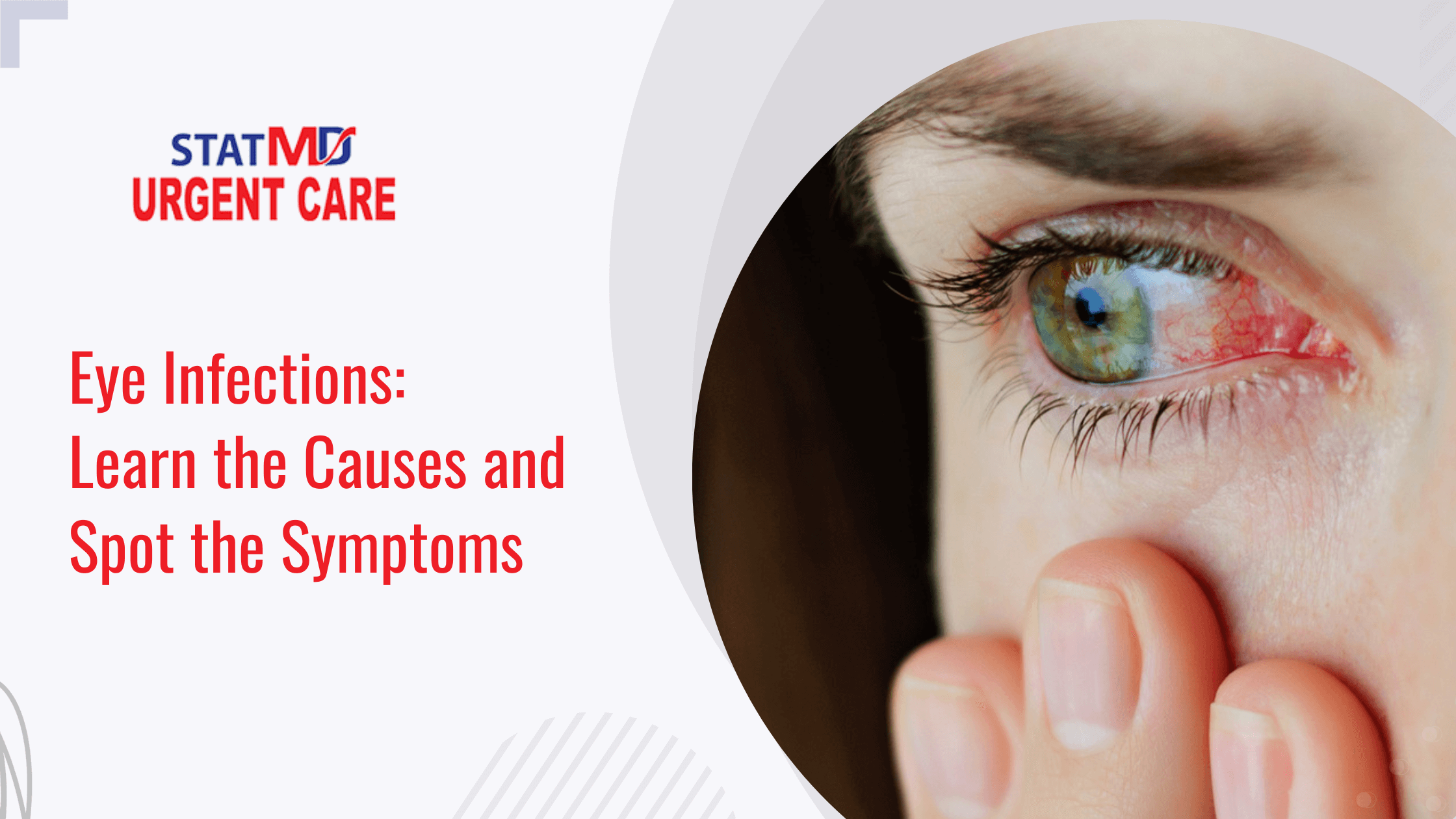 Eye Infections: Learn the Causes and Spot the Symptoms