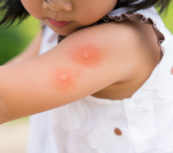 Walk into StatMD Urgent Care Clinic for Insect Bite Treatment