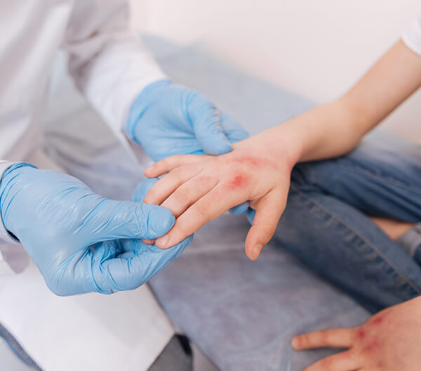 Treatment for Allergies
