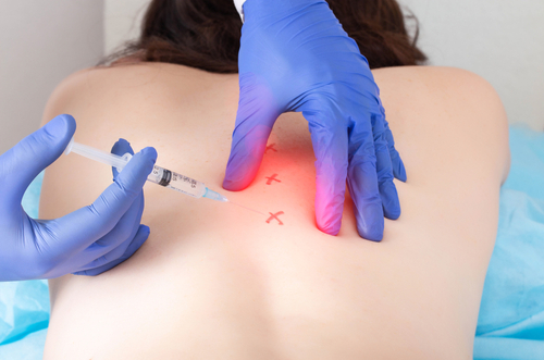 How a Caudal Epidural Injection Can Help Relieve Lower Back Ache? Doctor administering a caudal epidural injection to treat a patient’s lower back pain.