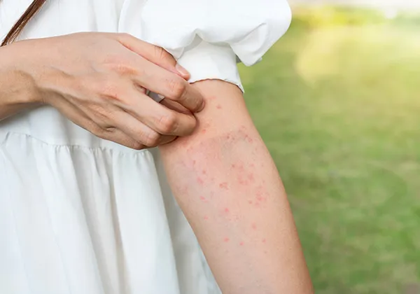 What Is an Allergic Reaction
