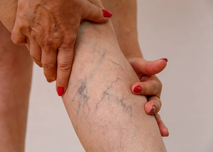Varicose Veins Treatment