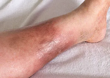 Chronic Venous Insufficiency Image