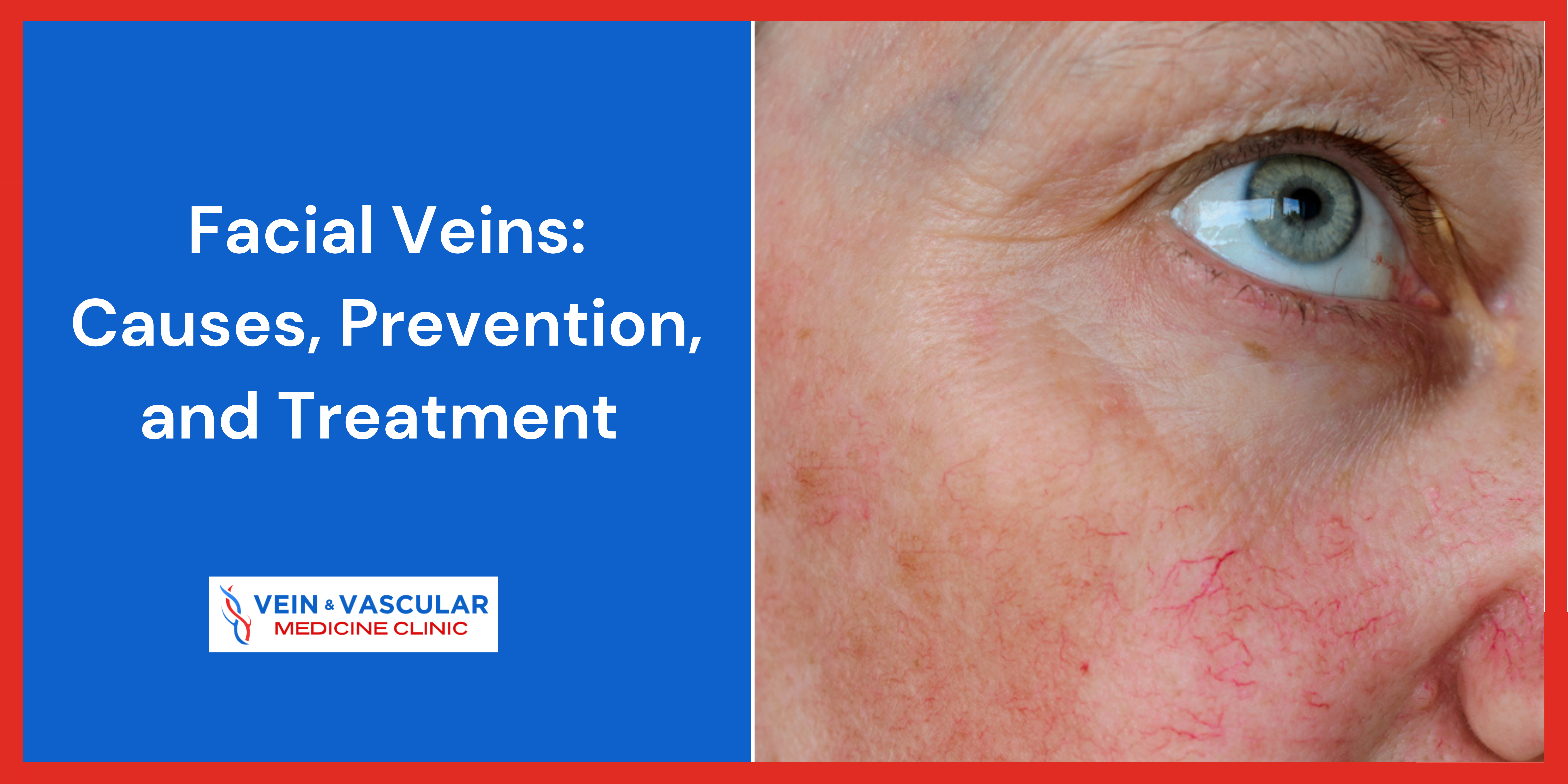 Facial Veins : Causes, Prevention, and Treatment
