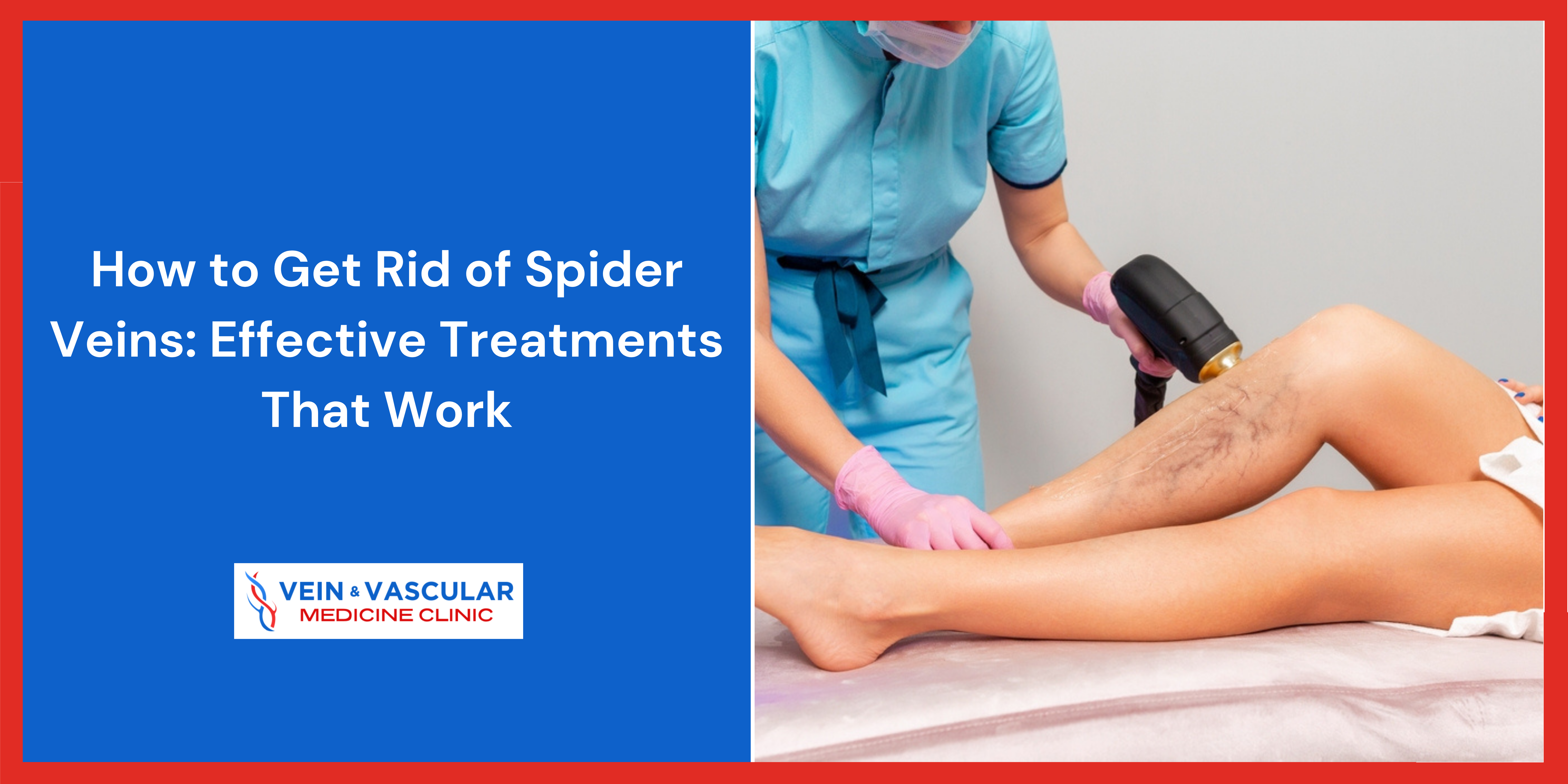 How to Get Rid of Spider Veins: Effective Treatments That Work