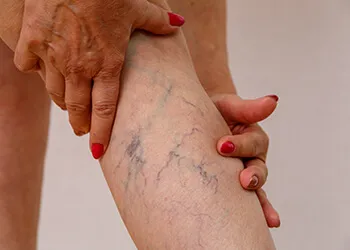 Spider Veins Image