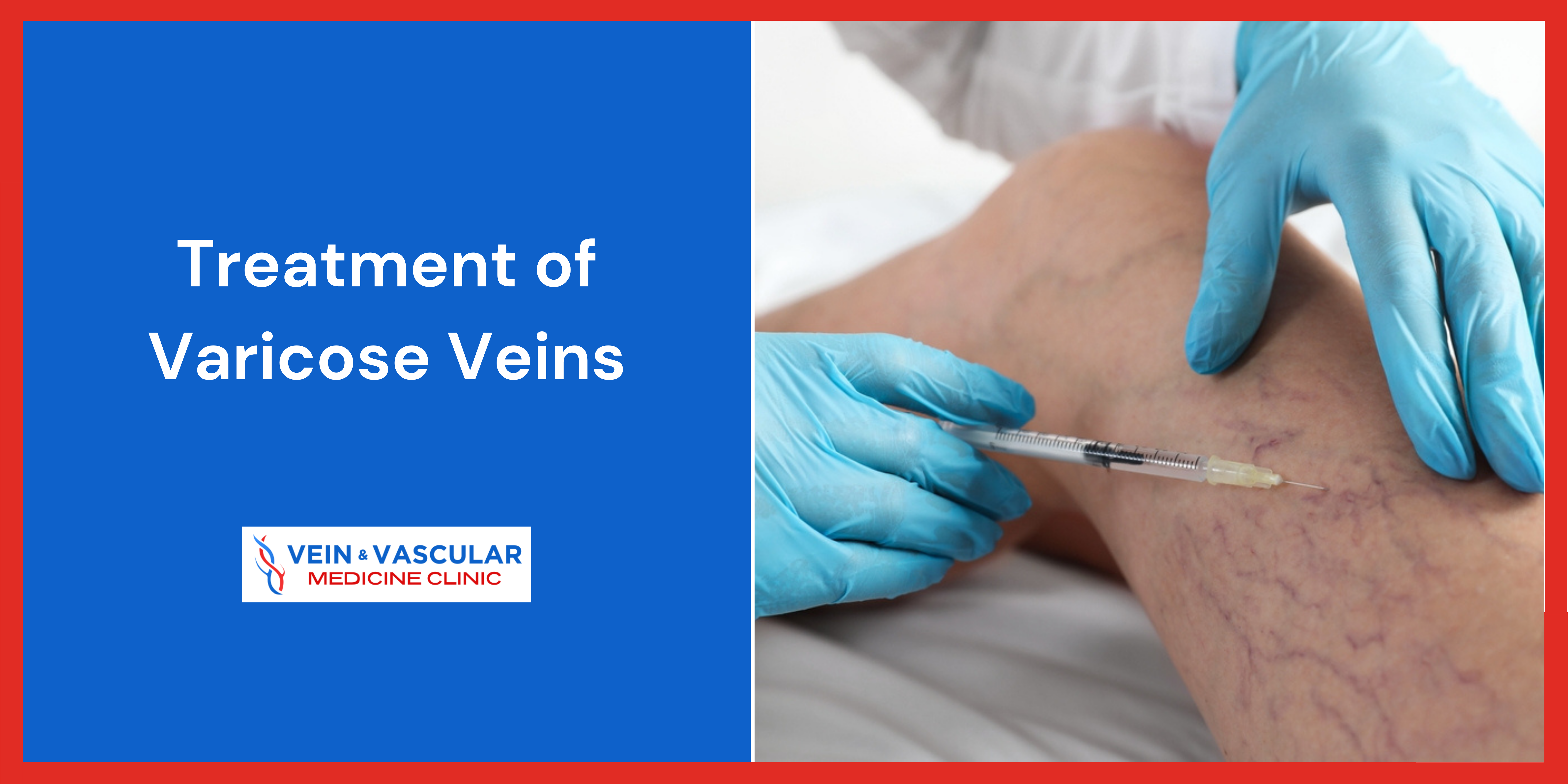 Treatment of Varicose Veins