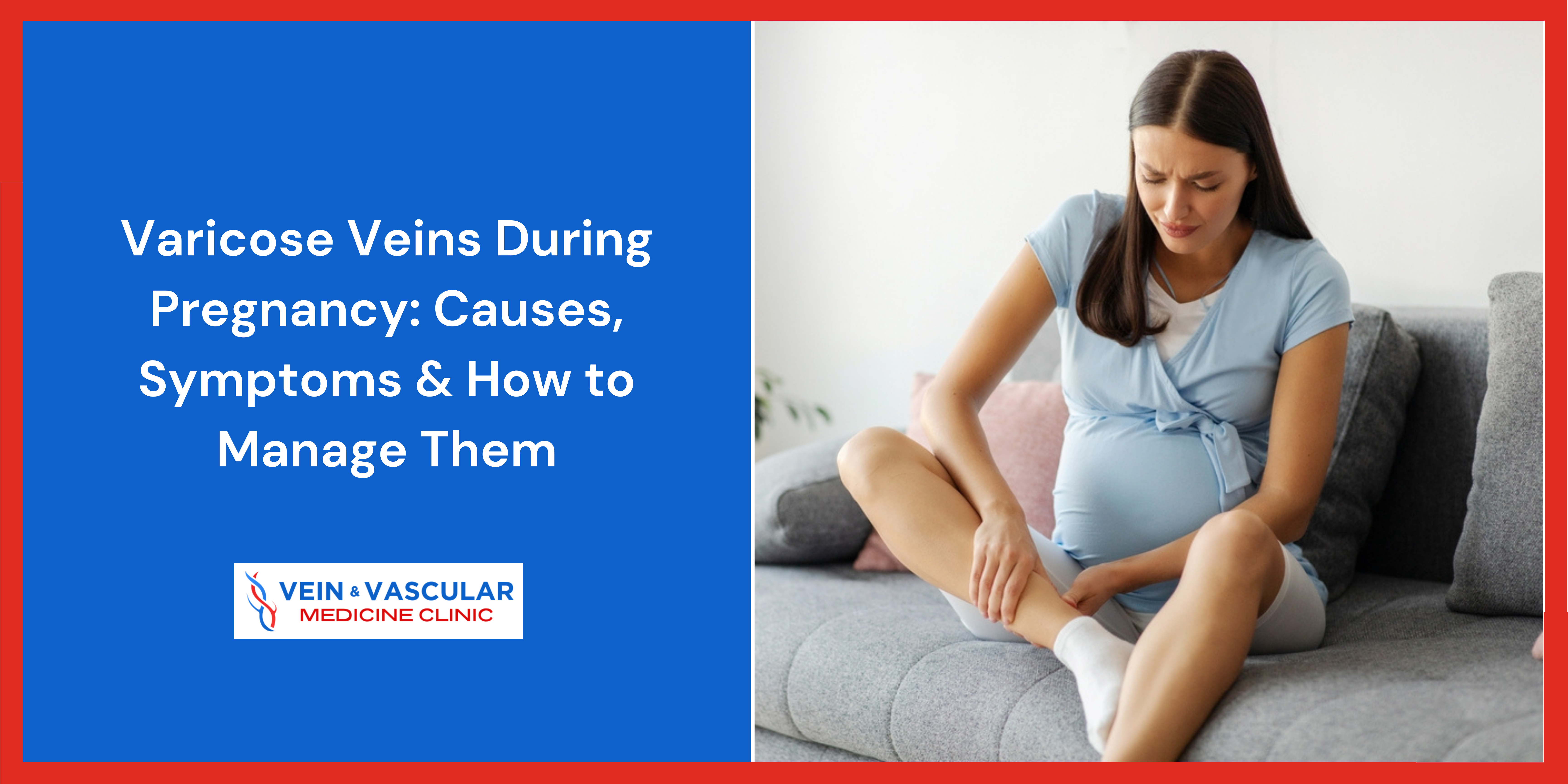 Varicose Veins in Pregnancy: Causes, Signs & Management Tips