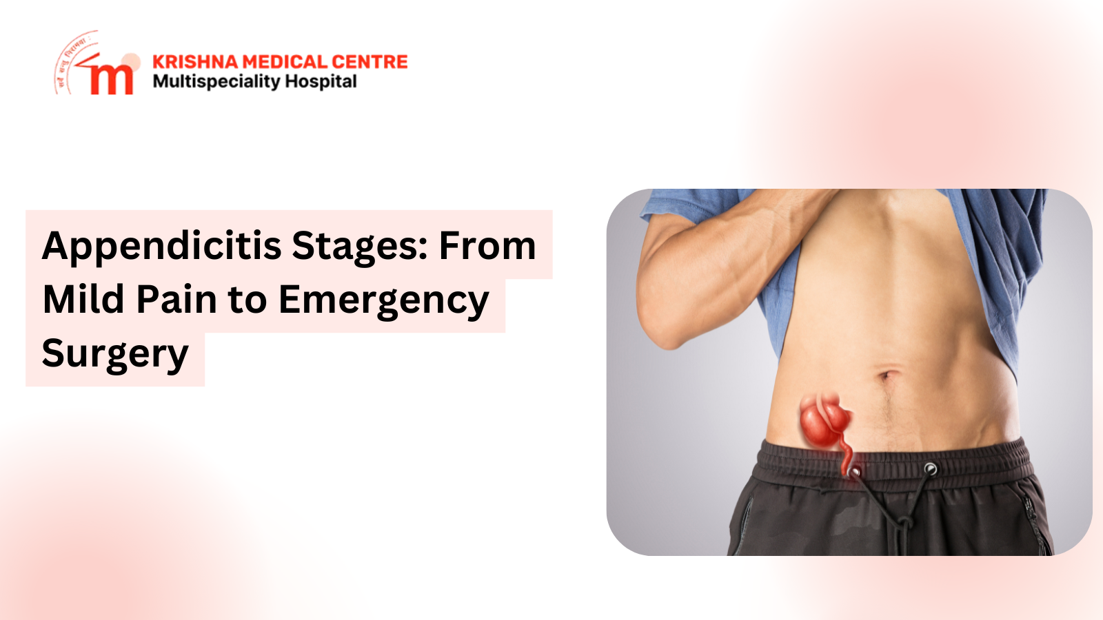 Appendicitis Stages: From Mild Pain to Emergency Surgery