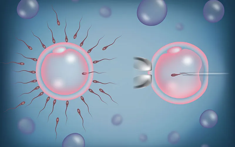 What is ICSI (Intracytoplasmic Sperm Injection)?