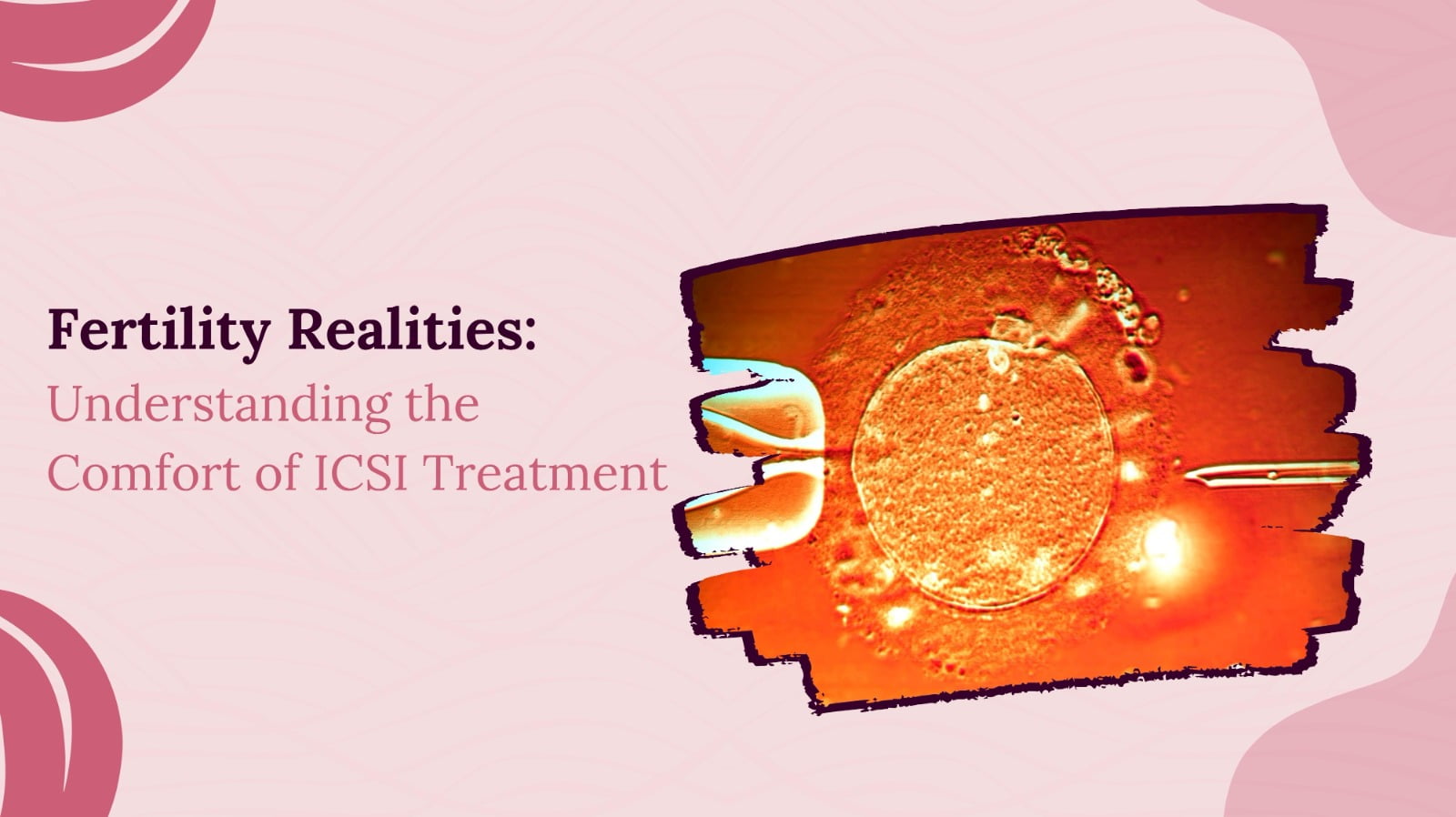 Fertility Realities: Understanding the Comfort of ICSI Treatment