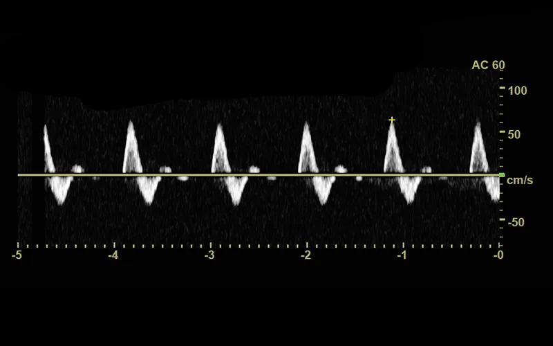 Arterial cms
