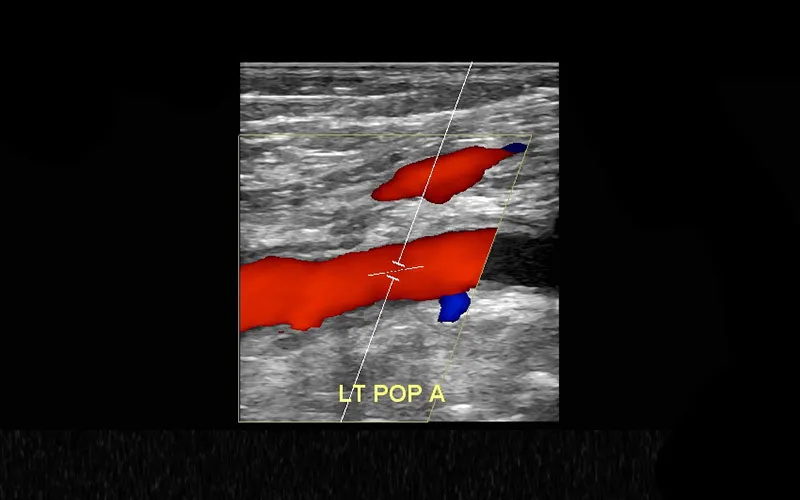 Arterial Duplex Cms