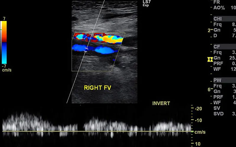 Arterial Duplex Scan