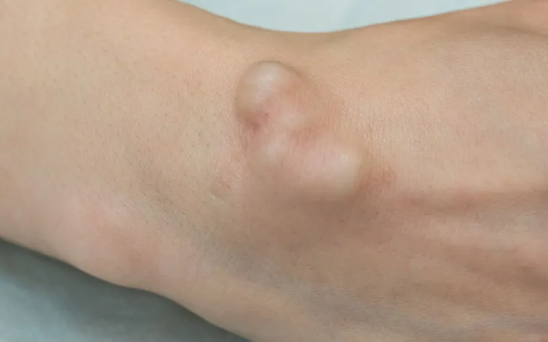 Arteriovenous and Aneurysmal Fistula Treatment