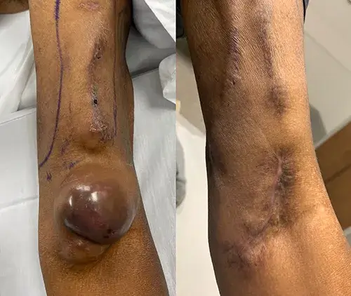 arteriovenous fistula