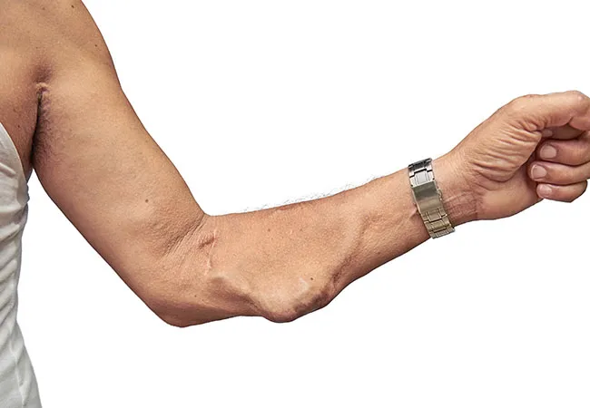 What Is Arteriovenous and Aneurysmal Fistula?