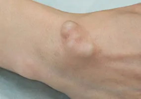 Aneurysmal Fistula