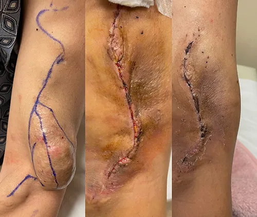av fistula