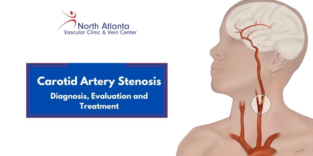 Carotid Artery Stenosis- Diagnosis, Evaluation and Treatment