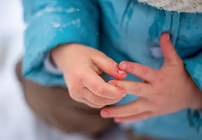 Treatment for Cold Hands