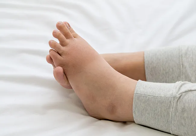 Signs and Symptoms of DVT