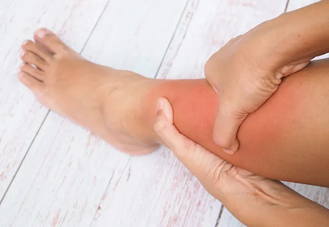 Complications of DVT