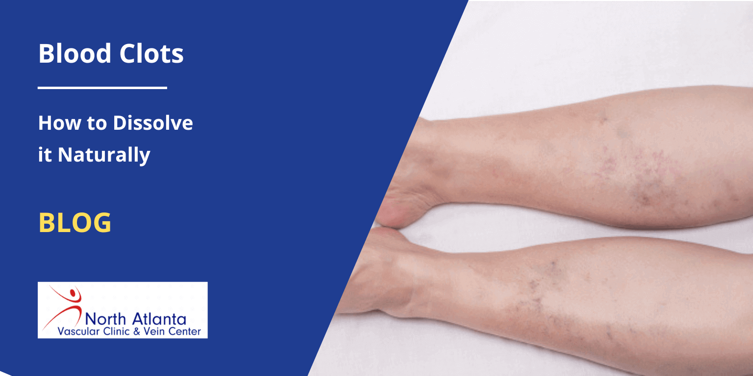 How to Dissolve Blood Clots Naturally