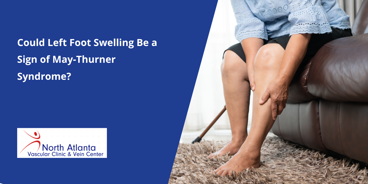 Could Left Foot Swelling Be a Sign of May-Thurner Syndrome?