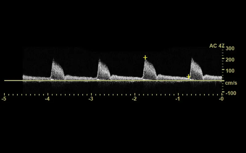 Mesentaric Artery Cms