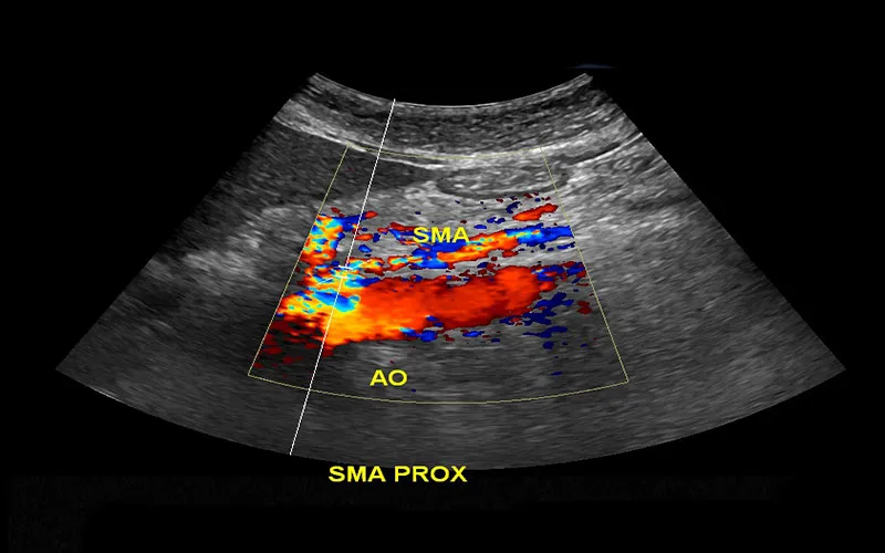 Mesentaric Artery Duplex Cms