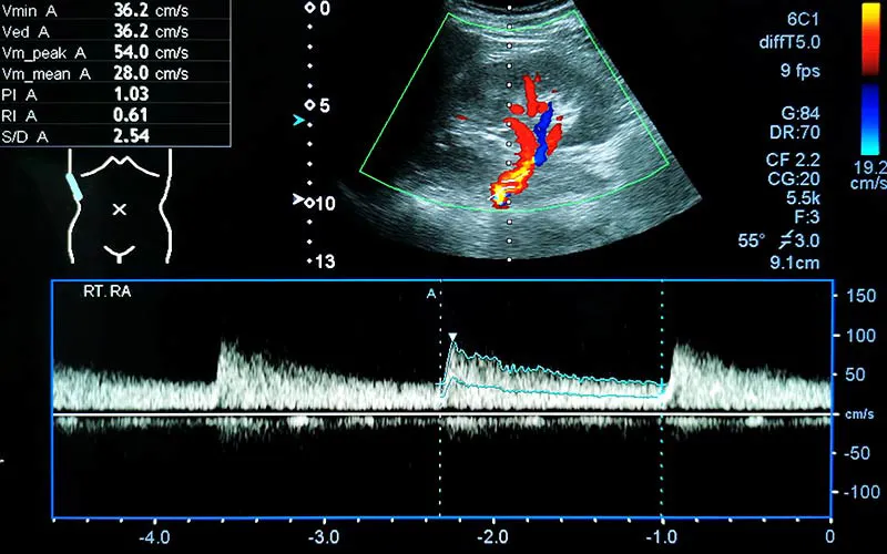 Mesenteric Artery Doppler Study